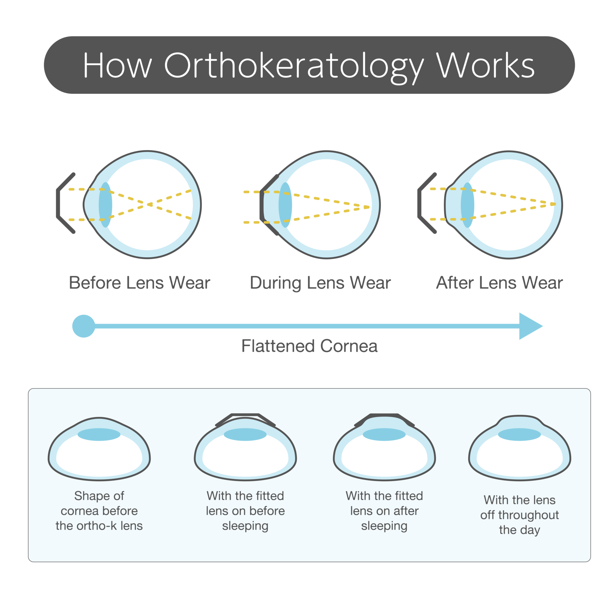 Orthokeratology Scott Eye Care